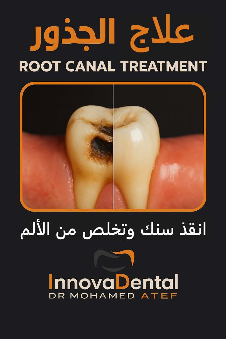 Root canal treatment